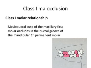 Class I malocclusion
Class I molar relationship
Mesiobuccal cusp of the maxillary first
molar occludes in the buccal groove of
the mandibular 1st permanent molar
168
 