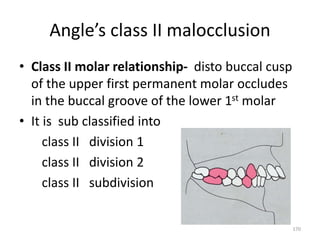 Angle’s class II malocclusion
• Class II molar relationship- disto buccal cusp
of the upper first permanent molar occludes
in the buccal groove of the lower 1st molar
• It is sub classified into
class II division 1
class II division 2
class II subdivision
170
 