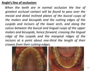 Angle’s line of occlusion:
When the teeth are in normal occlusion the line of
greatest occlusal contact will be found to pass over the
mesial and distal inclined planes of the buccal cusps of
the molars and bicuspids and the cutting edges of the
cuspids and incisors of the lower arch, and along the
sulcus between the buccal and lingual cusps of the upper
molars and bicuspids, hence forward, crossing the lingual
ridge of the cuspids and the marginal ridges of the
incisors at a point about one-third the length of their
crowns from their cutting-edges.
180
 