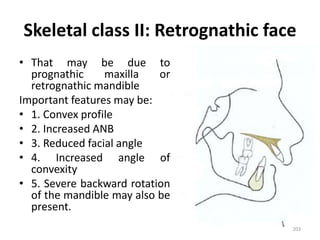 Skeletal class II: Retrognathic face
• That may be due to
prognathic maxilla or
retrognathic mandible
Important features may be:
• 1. Convex profile
• 2. Increased ANB
• 3. Reduced facial angle
• 4. Increased angle of
convexity
• 5. Severe backward rotation
of the mandible may also be
present.
203
 