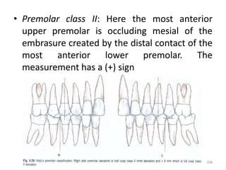 • Premolar class II: Here the most anterior
upper premolar is occluding mesial of the
embrasure created by the distal contact of the
most anterior lower premolar. The
measurement has a (+) sign
208
 