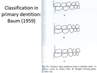 Classification in
primary dentition:
Baum (1959)
212
 