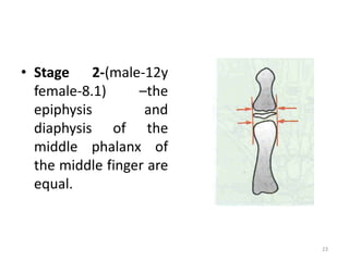 • Stage 2-(male-12y
female-8.1) –the
epiphysis and
diaphysis of the
middle phalanx of
the middle finger are
equal.
23
 