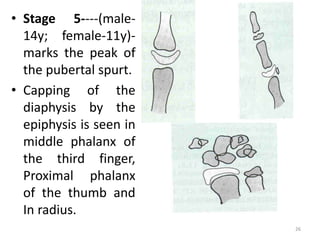 • Stage 5----(male-
14y; female-11y)-
marks the peak of
the pubertal spurt.
• Capping of the
diaphysis by the
epiphysis is seen in
middle phalanx of
the third finger,
Proximal phalanx
of the thumb and
In radius.
26
 