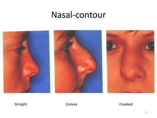 Nasal-contour
Straight Convex Crooked
55
 