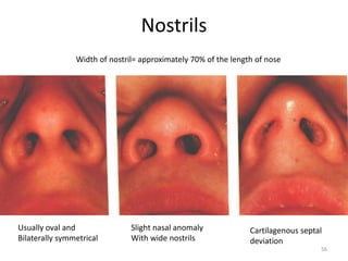 Nostrils
Width of nostril= approximately 70% of the length of nose
Usually oval and
Bilaterally symmetrical
Slight nasal anomaly
With wide nostrils
Cartilagenous septal
deviation
56
 