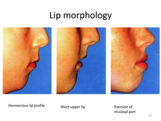 Lip morphology
Harmonious lip profile Short upper lip Eversion of
mucosal part
58
 