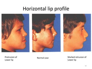 Horizontal lip profile
Protrusion of
Lower lip
Normal case Marked retrusion of
Lower lip
59
 