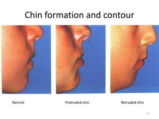 Chin formation and contour
Normal Protruded chin Retruded chin
62
 