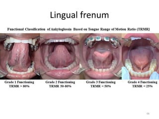 Lingual frenum
66
 