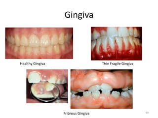 Gingiva
Healthy Gingiva Thin Fragile Gingiva
Fribrous Gingiva 69
 