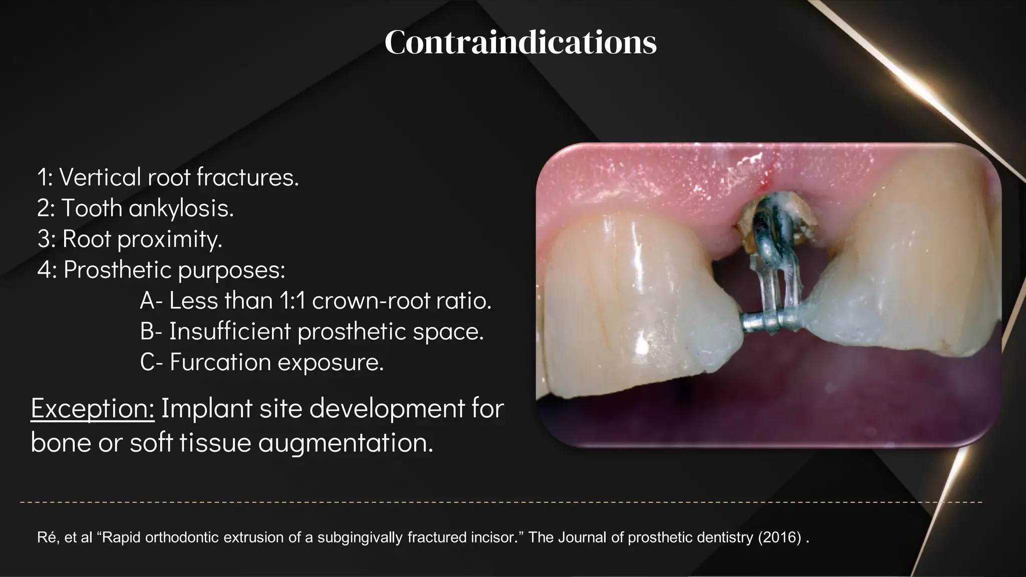 Extruded Teeth Orthodontic Extrusion | PDF