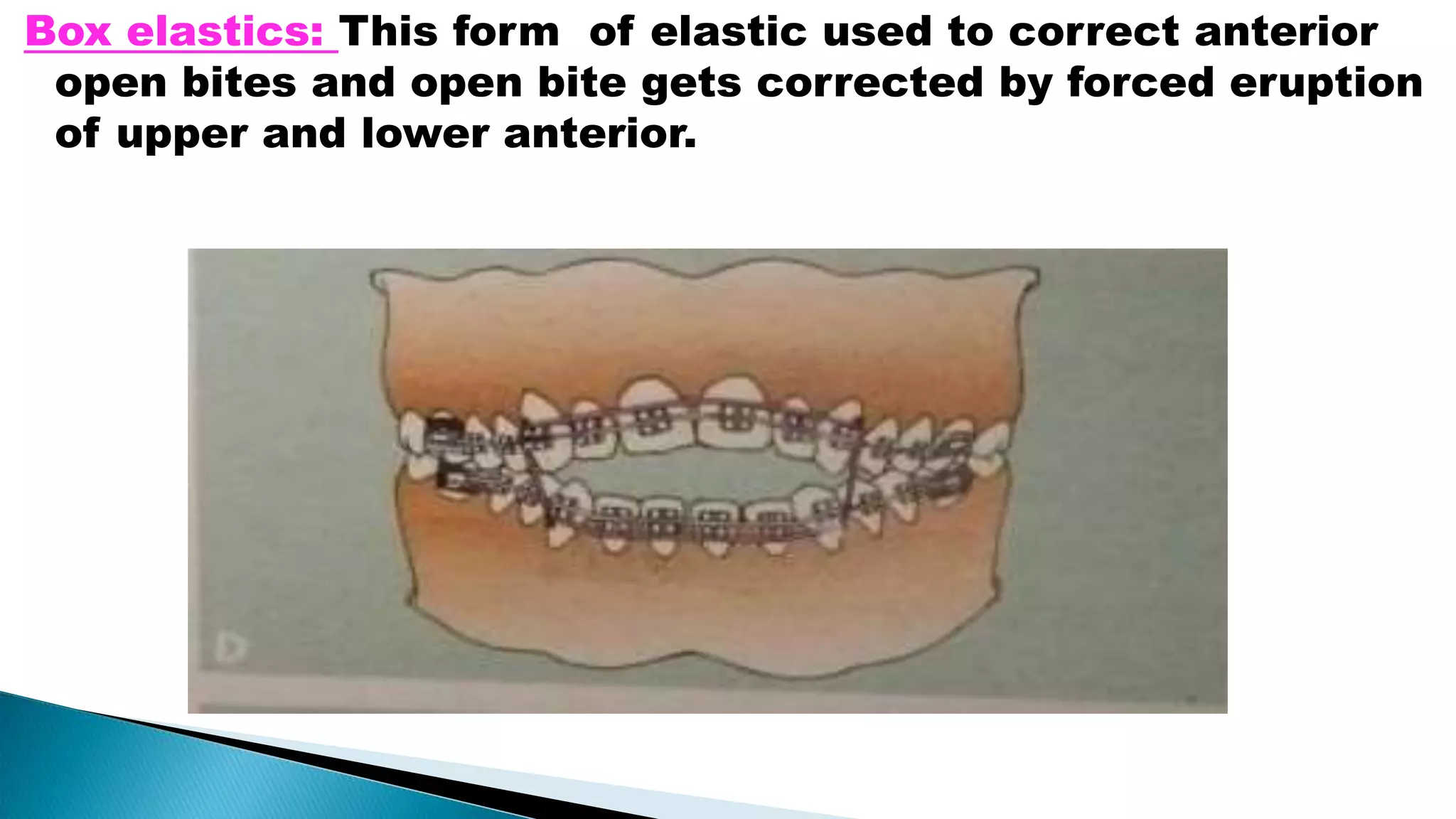Orthodontic fixed appliances | PPTX