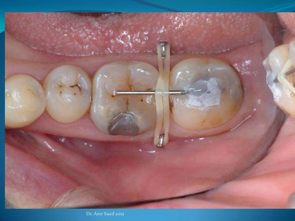 Orthodontic implants