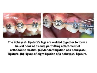 The Kobayashi ligature’s legs are welded together to form a
helical hook at its end, permitting attachment of
orthodontic elastics. (a) Standard ligation of a Kobayashi
ligature. (b) Figure-of-eight ligation of a Kobayashi ligature.
 