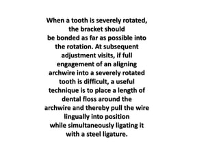 When a tooth is severely rotated,
the bracket should
be bonded as far as possible into
the rotation. At subsequent
adjustment visits, if full
engagement of an aligning
archwire into a severely rotated
tooth is difficult, a useful
technique is to place a length of
dental floss around the
archwire and thereby pull the wire
lingually into position
while simultaneously ligating it
with a steel ligature.
 