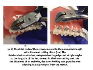 (a, b) The distal ends of the archwire are cut to the appropriate length
with distal-end cutting pliers. (c–e) The
distal-end wire cutter has juxtaposed cutting edges set at right angles
to the long axis of the instrument. As the inner cutting part cuts
the distal end of an archwire, the outer holding part grips the wire
allowing its easy removal from the mouth.
 