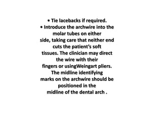 • Tie lacebacks if required.
• Introduce the archwire into the
molar tubes on either
side, taking care that neither end
cuts the patient’s soft
tissues. The clinician may direct
the wire with their
fingers or usingWeingart pliers.
The midline identifying
marks on the archwire should be
positioned in the
midline of the dental arch .
 