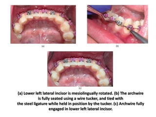 (a) Lower left lateral incisor is mesiolingually rotated. (b) The archwire
is fully seated using a wire tucker, and tied with
the steel ligature while held in position by the tucker. (c) Archwire fully
engaged in lower left lateral incisor.
 