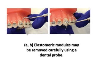(a, b) Elastomeric modules may
be removed carefully using a
dental probe.
 