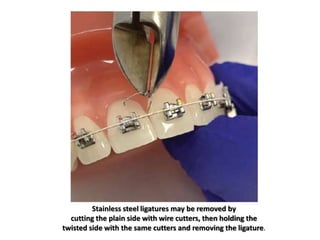 Stainless steel ligatures may be removed by
cutting the plain side with wire cutters, then holding the
twisted side with the same cutters and removing the ligature.
 
