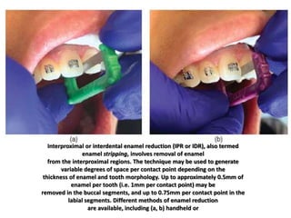 Interproximal or interdental enamel reduction (IPR or IDR), also termed
enamel stripping, involves removal of enamel
from the interproximal regions. The technique may be used to generate
variable degrees of space per contact point depending on the
thickness of enamel and tooth morphology. Up to approximately 0.5mm of
enamel per tooth (i.e. 1mm per contact point) may be
removed in the buccal segments, and up to 0.75mm per contact point in the
labial segments. Different methods of enamel reduction
are available, including (a, b) handheld or
 