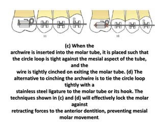 (c) When the
archwire is inserted into the molar tube, it is placed such that
the circle loop is tight against the mesial aspect of the tube,
and the
wire is tightly cinched on exiting the molar tube. (d) The
alternative to cinching the archwire is to tie the circle loop
tightly with a
stainless steel ligature to the molar tube or its hook. The
techniques shown in (c) and (d) will effectively lock the molar
against
retracting forces to the anterior dentition, preventing mesial
molar movement.
 