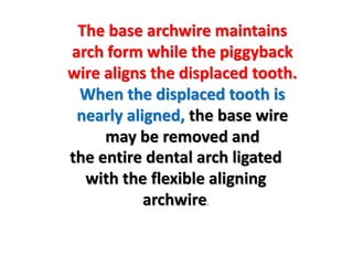 The base archwire maintains
arch form while the piggyback
wire aligns the displaced tooth.
When the displaced tooth is
nearly aligned, the base wire
may be removed and
the entire dental arch ligated
with the flexible aligning
archwire.
 