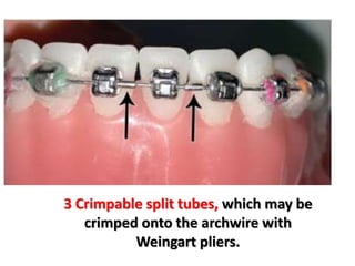 3 Crimpable split tubes, which may be
crimped onto the archwire with
Weingart pliers.
 