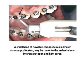 A small bead of flowable composite resin, known
as a composite stop, may be run onto the archwire in an
interbracket span and light cured.
 