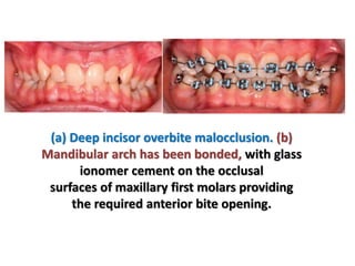(a) Deep incisor overbite malocclusion. (b)
Mandibular arch has been bonded, with glass
ionomer cement on the occlusal
surfaces of maxillary first molars providing
the required anterior bite opening.
 
