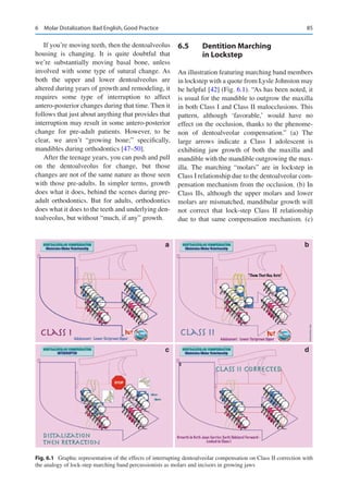 Orthodontic Management of Class II Manejo de ortodoncia en clase II | PDF