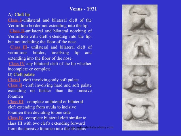 bilateral cleft lip