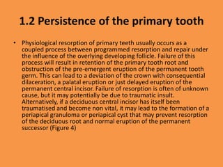 1.2 Persistence of the primary tooth
• Physiological resorption of primary teeth usually occurs as a
coupled process between programmed resorption and repair under
the influence of the overlying developing follicle. Failure of this
process will result in retention of the primary tooth root and
obstruction of the pre-emergent eruption of the permanent tooth
germ. This can lead to a deviation of the crown with consequential
dilaceration, a palatal eruption or just delayed eruption of the
permanent central incisor. Failure of resorption is often of unknown
cause, but it may potentially be due to traumatic insult.
Alternatively, if a deciduous central incisor has itself been
traumatised and become non vital, it may lead to the formation of a
periapical granuloma or periapical cyst that may prevent resorption
of the deciduous root and normal eruption of the permanent
successor (Figure 4)
 