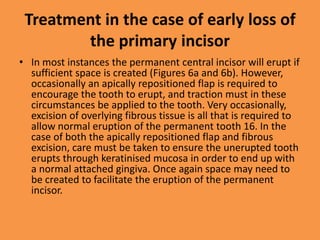 Treatment in the case of early loss of
the primary incisor
• In most instances the permanent central incisor will erupt if
sufficient space is created (Figures 6a and 6b). However,
occasionally an apically repositioned flap is required to
encourage the tooth to erupt, and traction must in these
circumstances be applied to the tooth. Very occasionally,
excision of overlying fibrous tissue is all that is required to
allow normal eruption of the permanent tooth 16. In the
case of both the apically repositioned flap and fibrous
excision, care must be taken to ensure the unerupted tooth
erupts through keratinised mucosa in order to end up with
a normal attached gingiva. Once again space may need to
be created to facilitate the eruption of the permanent
incisor.
 