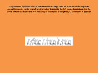 Diagrammatic representation of the treatment strategy used for eruption of the impacted
central incisor: A, elastic chain from the incisor bracket to the left canine bracket causing the
crown to tip distally and the root mesially; B, the incisor is uprighted; C, the incisor in position
 