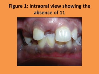 Figure 1: Intraoral view showing the
absence of 11
 