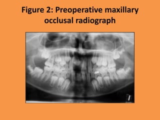 Figure 2: Preoperative maxillary
occlusal radiograph
 