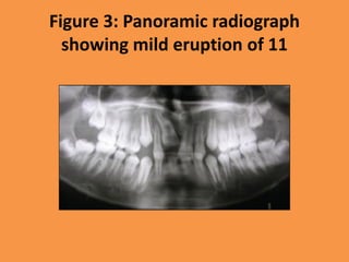 Figure 3: Panoramic radiograph
showing mild eruption of 11
 