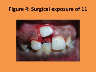 Figure 4: Surgical exposure of 11
 