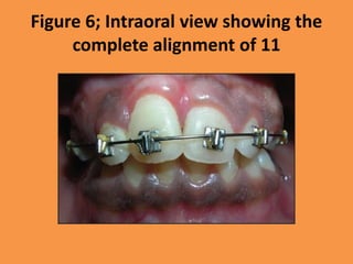 Figure 6; Intraoral view showing the
complete alignment of 11
 