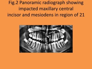 Fig.2 Panoramic radiograph showing
impacted maxillary central
incisor and mesiodens in region of 21
 