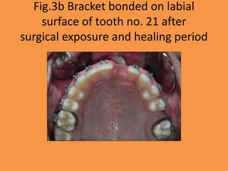 Fig.3b Bracket bonded on labial
surface of tooth no. 21 after
surgical exposure and healing period
 