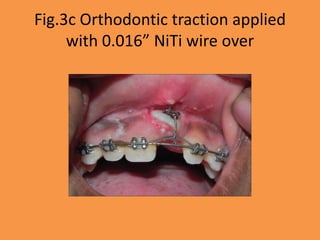 Fig.3c Orthodontic traction applied
with 0.016” NiTi wire over
 