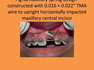 Fig.4a Auxiliary spring design-
constructed with 0.016 × 0.022″ TMA
wire to upright horizontally impacted
maxillary central incisor
 
