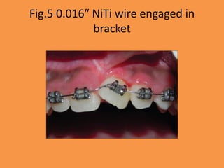 Fig.5 0.016″ NiTi wire engaged in
bracket
 