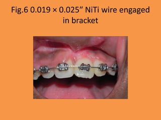 Fig.6 0.019 × 0.025″ NiTi wire engaged
in bracket
 