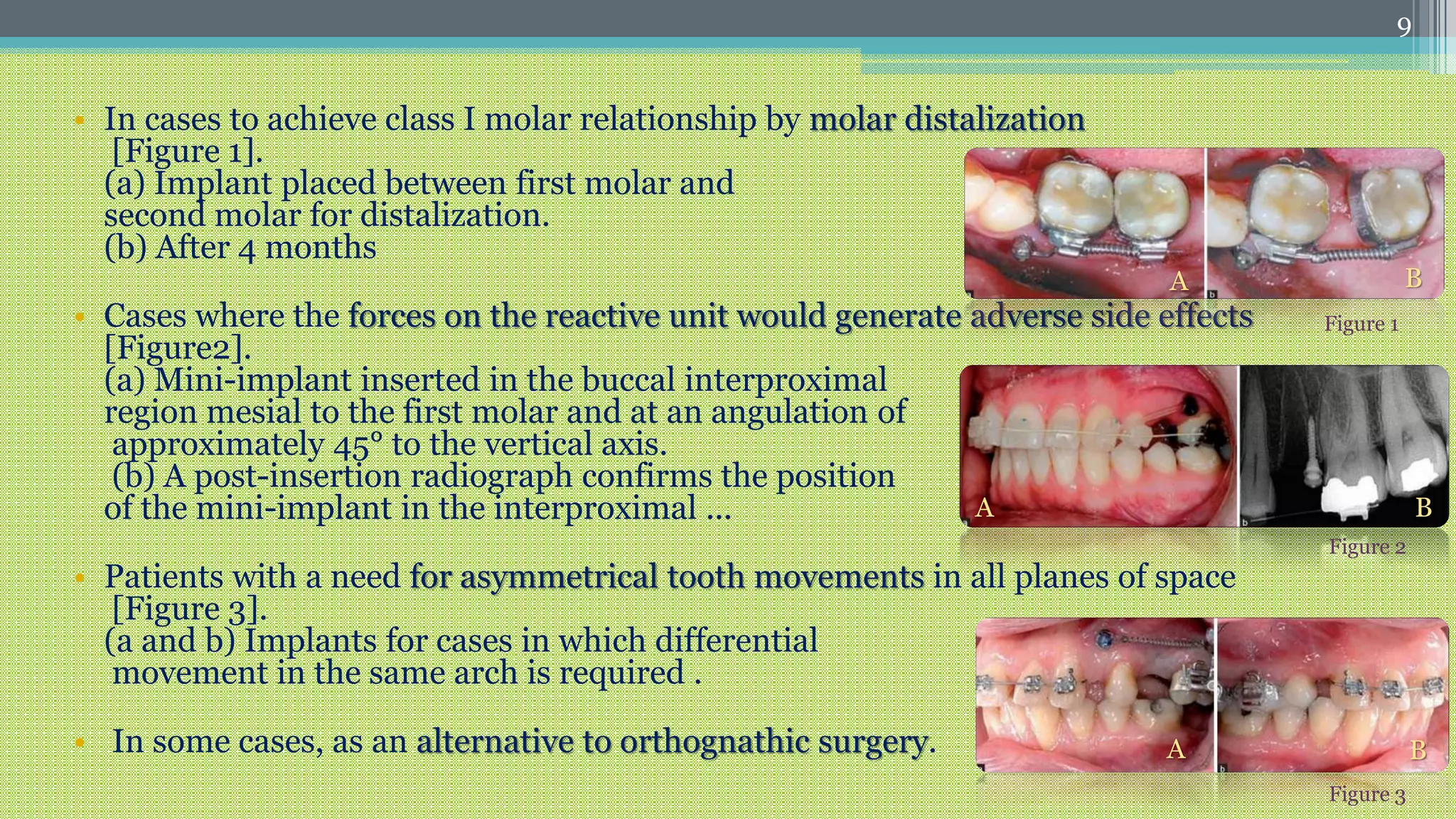 Orthodontic mini implant | PPTX