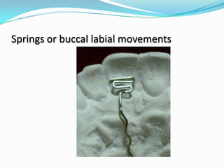 Springs or buccal labial movements
 