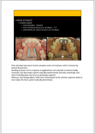 Orthodontic retraction biomechanics for space closure and distalization ...